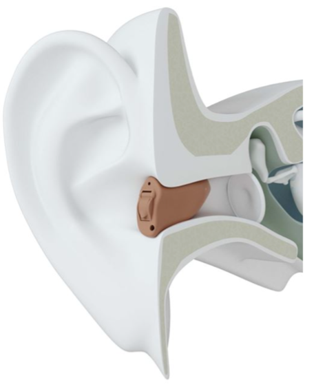 Hearing-Aid-Type-5-Completely in canal